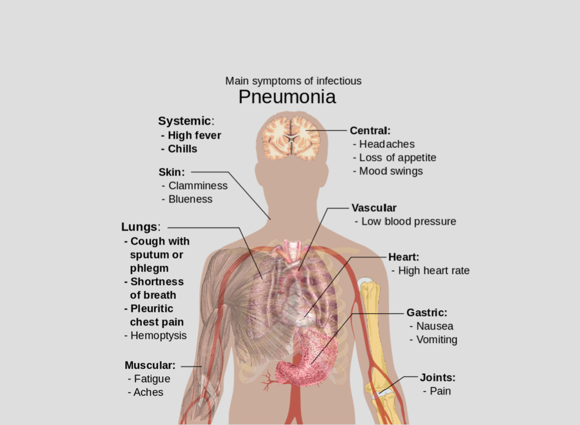 Pneumonia の意味 例文 発音 語源 イメージ画像 Kotoba